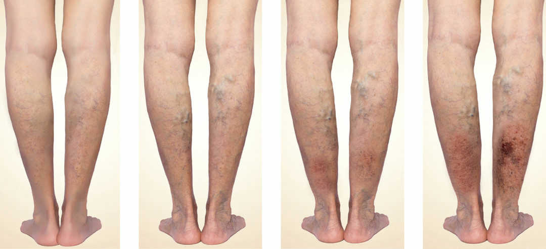 Varicose veins - Symptoms and causes - Mayo Clinic